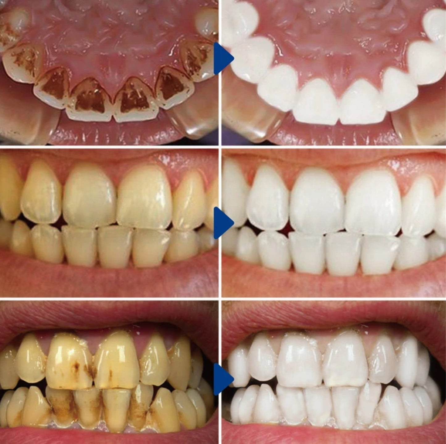 Irrigador Dental Profesional+ GRATIS Blanqueador Dental a tan solo $629😯